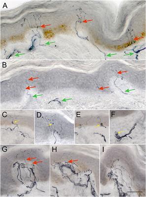 Increased Intraepidermal Nerve Fiber Degeneration and Impaired Regeneration Relate to Symptoms and Deficits in Parkinson's Disease